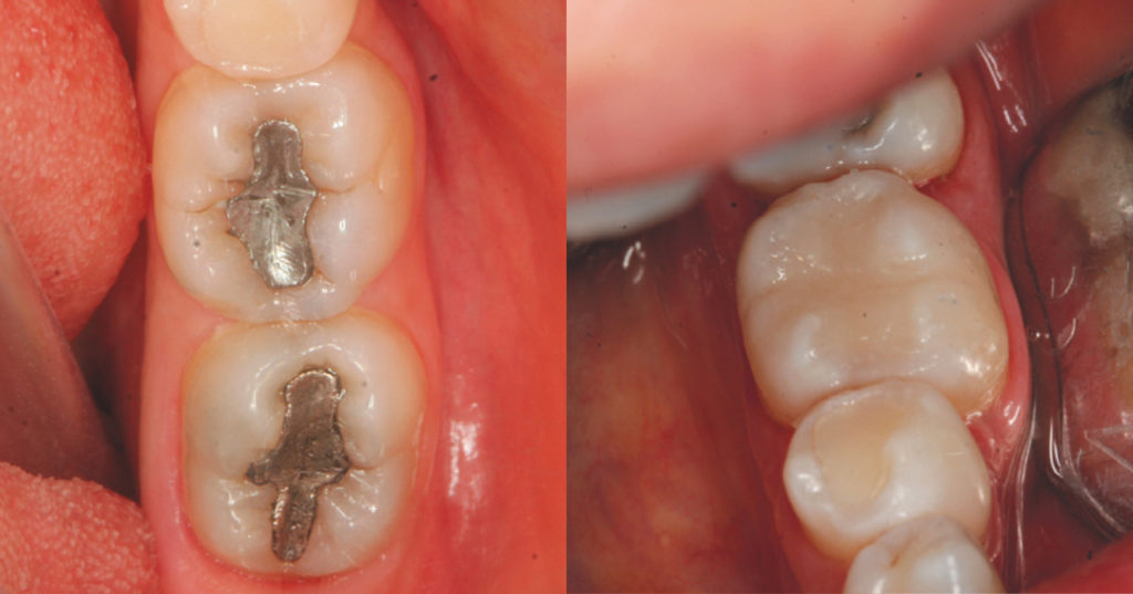 Cárie Dentária e Dentisteria GlamoursmileGlamoursmile Cárie Dentária e Dentisteria GlamoursmileGlamoursmile